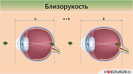 Заболевания глаз биология 8 класс. Заболевание и повреждение глаз биология 8 класс. Заболевания и повреждения глаз близорукость и дальнозоркость. Болезни органов зрения биология. Заболевания и повреждения глаз презентация.